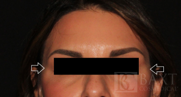 BOTOX® Cosmetic After - Paramus, NJ BOTOX® Cosmetic After - Paramus, NJ