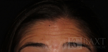 BOTOX® Cosmetic Before - Paramus, NJ BOTOX® Cosmetic Before - Paramus, NJ