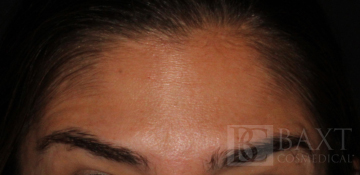 BOTOX® Cosmetic After - Paramus, NJ BOTOX® Cosmetic After - Paramus, NJ