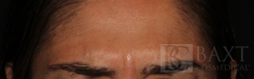 BOTOX® Cosmetic After - Paramus, NJ BOTOX® Cosmetic After - Paramus, NJ