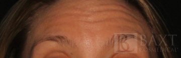 BOTOX® Cosmetic Before - Paramus, NJ BOTOX® Cosmetic Before - Paramus, NJ
