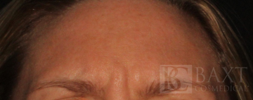BOTOX® Cosmetic Before - Paramus, NJ BOTOX® Cosmetic Before - Paramus, NJ