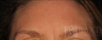 BOTOX® Cosmetic After - Paramus, NJ BOTOX® Cosmetic After - Paramus, NJ