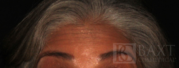 BOTOX® Cosmetic Before - Paramus, NJ BOTOX® Cosmetic Before - Paramus, NJ
