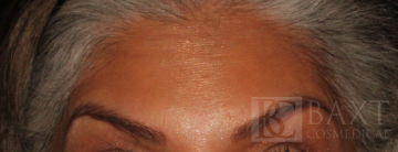 BOTOX® Cosmetic After - Paramus, NJ BOTOX® Cosmetic After - Paramus, NJ