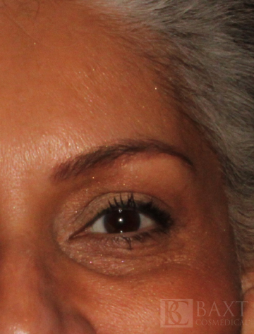 BOTOX® Cosmetic After - Paramus, NJ BOTOX® Cosmetic After - Paramus, NJ