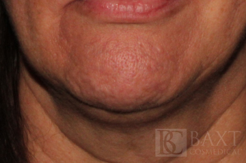 BOTOX® Cosmetic Before - Paramus, NJ BOTOX® Cosmetic Before - Paramus, NJ