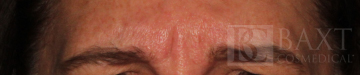 BOTOX® Cosmetic Before - Paramus, NJ BOTOX® Cosmetic Before - Paramus, NJ