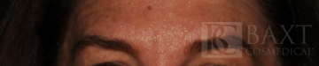 BOTOX® Cosmetic After - Paramus, NJ BOTOX® Cosmetic After - Paramus, NJ