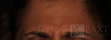 BOTOX® Cosmetic Before - Paramus, NJ