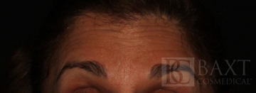 BOTOX® Cosmetic Before - Paramus, NJ