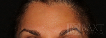 BOTOX® Cosmetic After - Paramus, NJ