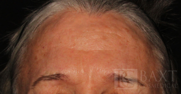BOTOX® Cosmetic After - Paramus, NJ