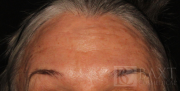 BOTOX® Cosmetic After - Paramus, NJ