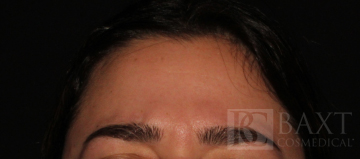 BOTOX® Cosmetic Before - Paramus, NJ