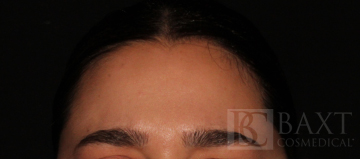 BOTOX® Cosmetic After - Paramus, NJ