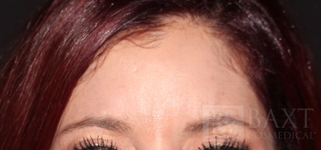 BOTOX® Cosmetic After - Paramus, NJ