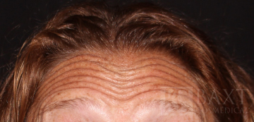 BOTOX® Cosmetic Before - Paramus, NJ