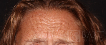 BOTOX® Cosmetic Before - Paramus, NJ