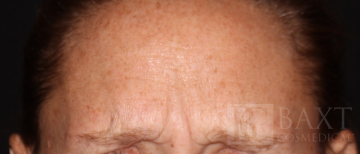 BOTOX® Cosmetic After - Paramus, NJ