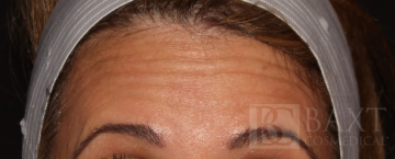 BOTOX® Cosmetic Before - Paramus, NJ