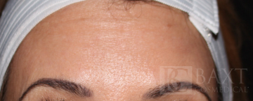 BOTOX® Cosmetic After - Paramus, NJ