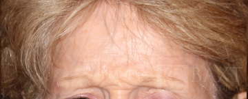 BOTOX® Cosmetic Before - Paramus, NJ