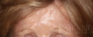 BOTOX® Cosmetic After - Paramus, NJ