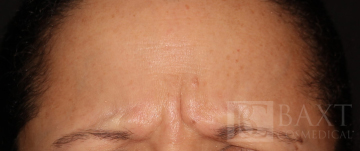 BOTOX® Cosmetic Before - Paramus, NJ