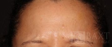 BOTOX® Cosmetic After - Paramus, NJ
