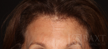 BOTOX® Cosmetic After - Paramus, NJ