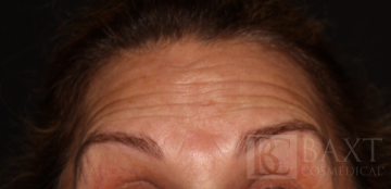 BOTOX® Cosmetic Before - Paramus, NJ