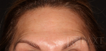 BOTOX® Cosmetic After - Paramus, NJ