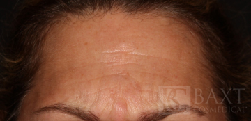 BOTOX® Cosmetic Before - Paramus, NJ