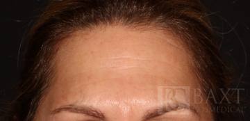 BOTOX® Cosmetic After - Paramus, NJ