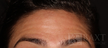 BOTOX® Cosmetic Before - Paramus, NJ