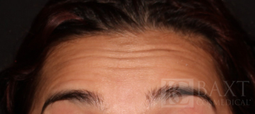 BOTOX® Cosmetic Before - Paramus, NJ