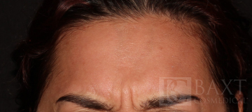 BOTOX® Cosmetic Before - Paramus, NJ