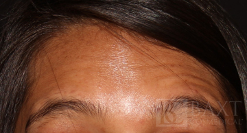 BOTOX® Cosmetic Before - Paramus, NJ