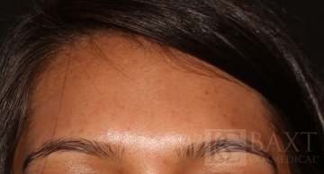 BOTOX® Cosmetic After - Paramus, NJ