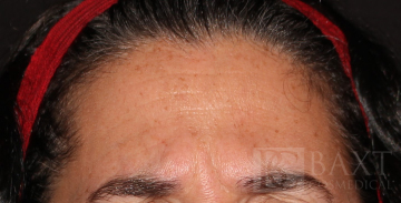 BOTOX® Cosmetic Before - Paramus, NJ