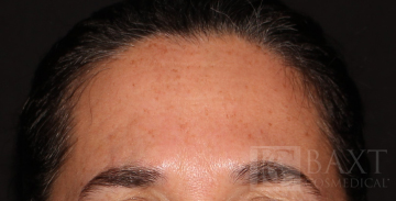 BOTOX® Cosmetic After - Paramus, NJ