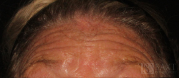 BOTOX® Cosmetic Before - Paramus, NJ