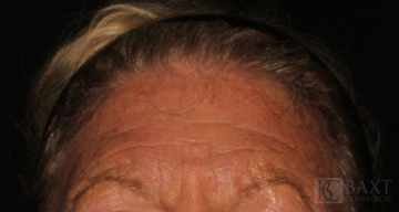 BOTOX® Cosmetic Before - Paramus, NJ