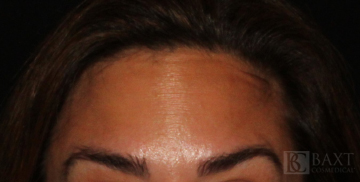 BOTOX® Cosmetic After - Paramus, NJ