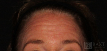 BOTOX® Cosmetic Before - Paramus, NJ