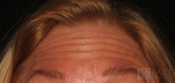 BOTOX® Cosmetic Before - Paramus, NJ