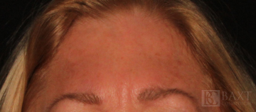 BOTOX® Cosmetic Before - Paramus, NJ