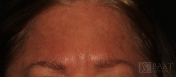 BOTOX® Cosmetic After - Paramus, NJ