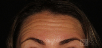 BOTOX® Cosmetic Before - Paramus, NJ